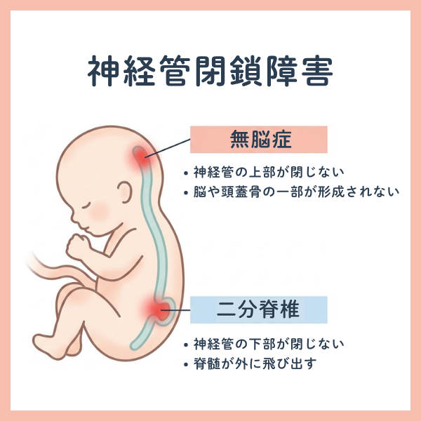 葉酸不足による神経管閉鎖障害
